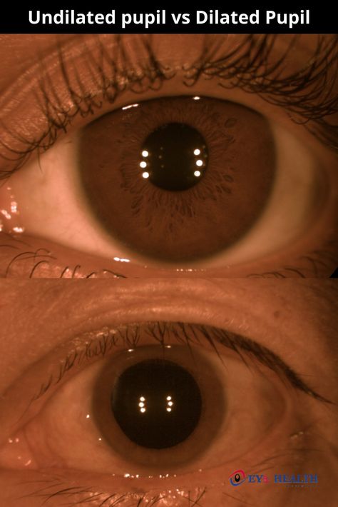 Undilated Pupil vs Dilated Pupil Pupil Dilation, Dilated Eyes, Eye Examination, Dilated Pupils, Hospital Clinic, Optic Nerve, Eye Hospital, Eye Drops, Eye Health