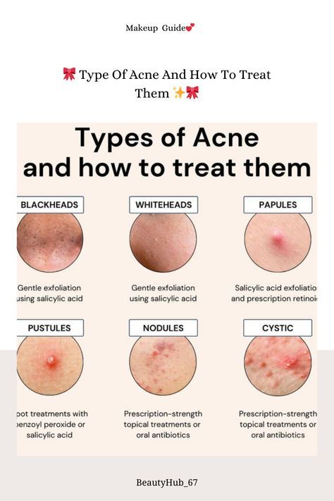 #skin car beaute tips makeup 2024 Clyndamiacin For Acne, What Does My Acne Mean, How To Get Rid Of Nodules Acne, Homemade Foot Mask, Fungle Acne, Acne Guide, Ingredients For Oily Skin, Papules Acne, Remove Whiteheads