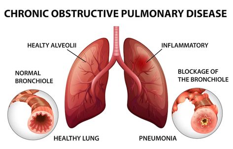 Home Remedies For Bronchitis, Arterial Blood Gas, Nclex Questions, Lung Conditions, Lung Transplant, Healthy Lungs, Oxygen Therapy, Chronic Obstructive Pulmonary Disease, Respiratory Infection