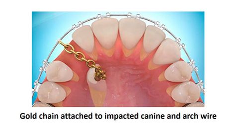 Extra Teeth, Canine Teeth, Teeth Surgery, Impacted Tooth, Gum Surgery, Molar Tooth, Canine Tooth, Oral Surgeon, Human Teeth