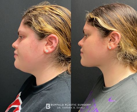 Double Chin Lipo Before And After, Chin Lipo Before And After, Plastic Aesthetic, Lipo Before And After, Facial Structure, Fat Transfer, Sauna Suit, Buffalo New York, Double Chin