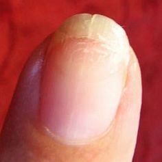 Here's how to repair split fingernails--try it, it really works! Split Nail Repair, Fix Broken Nail, Fingernail Health, Nail Remedies, Nail Ridges, Split Nails, Peeling Nails, Nails Care, Natural Detergent