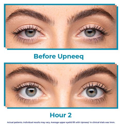 This New Eye Drop Lifts Droopy Eyelids Without Surgery - NewBeauty Cat Eye Surgery, How To Fix Droopy Eyelids, Uneven Eyelids, Fix Droopy Eyelids, Upper Eyelid Lift Surgery, Eye Enlargement Surgery, Eye Lift Surgery, Best Eye Drops, Fox Eye Lift Surgery