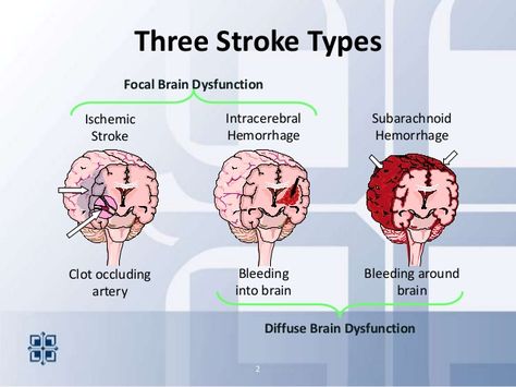 types of strokes | 2013.stroke areyouready Types Of Strokes Nursing, Emt Study, Types Of Strokes, Nurse Study Notes, Medical Student Study, Cardiac Nursing, Nursing School Survival, Nursing School Studying, Med Surg