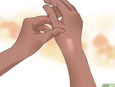 Expert Advice on How to Identify and Treat Ringworm - wikiHow Ringworms In Humans, Kids Skin Care, Antifungal Cream, Natural Remedies For Migraines, Human Pictures, Dry Skin Remedies, Dark Underarms, Dry Skin Patches, Home Remedies For Hair