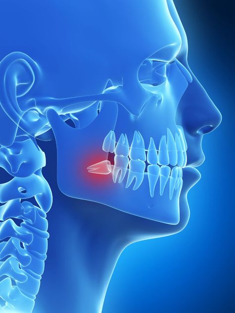 Impacted Wisdom Teeth, After Wisdom Teeth Removal, Teeth Surgery, Impacted Tooth, Wisdom Tooth Extraction, Oral Maxillofacial, Dental Check Up, Jaw Surgery, Swollen Gum