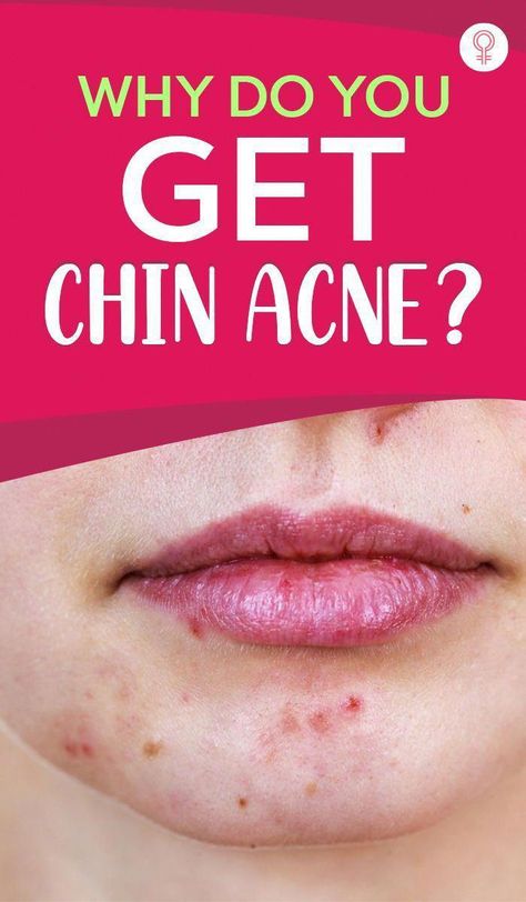 Chin Acne, Back Acne Remedies, Blind Pimple, Forehead Acne, Pimples Under The Skin, Bad Acne, Acne Overnight, Prevent Pimples, Natural Acne Remedies