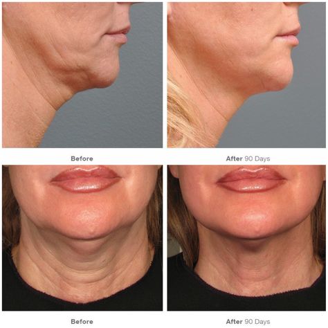 Ultherapy Before And After, Infected Ingrown Hair, Hide Wrinkles, Non Surgical Facelift, Plasma Pen, Face Treatments, Kathie Lee Gifford, Improve Vision, Skin Peel