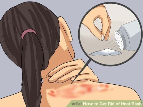 Heat Rash On Face, Treating Heat Rash, Heat Bumps, Heat Rash Remedy, Home Remedies For Rashes, Prickly Heat Rash, Allergy Rash, Rash On Face, Rash On Neck