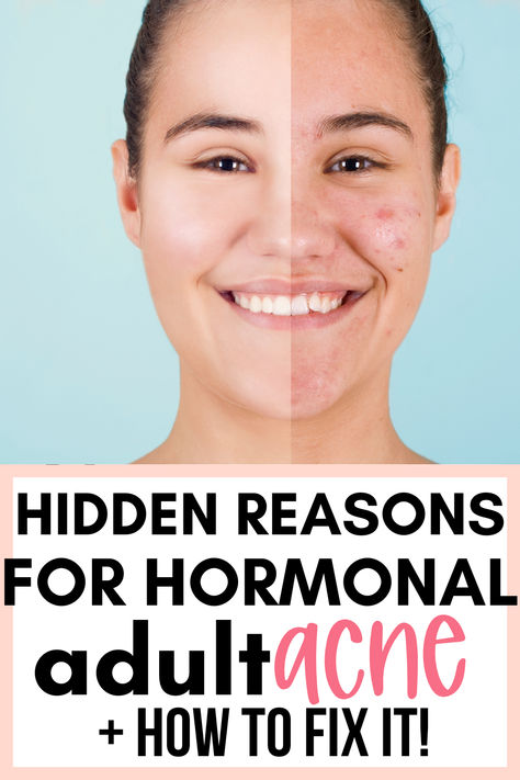 #acne #acnetreatment #naturalacnetreatment Hormonal Acne Causes, How To Treat Hormonal Acne Naturally, What Causes Back Acne, Fastest Way To Get Rid Of Pimples, How To Get Rid Of Blemishes, Acne Breakout Chart, Acne In Your 30s, Acne At Age 40, Treating Hormonal Acne