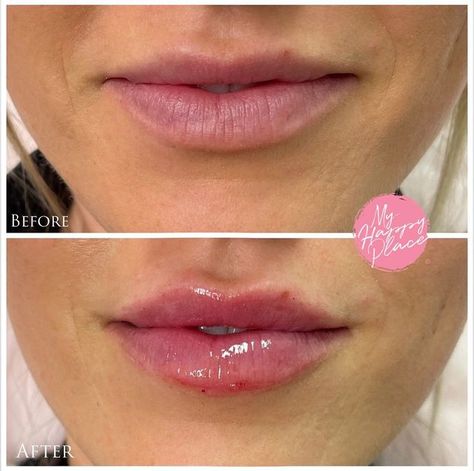 Lip Filler Half Syringe, Half Syringe Lip Filler, Upper Lip Filler, Half Syringe Lip Filler Before And After, Juvederm Lips, Lips Inspiration, Holiday Lip, Lip Filler, Lip Injections