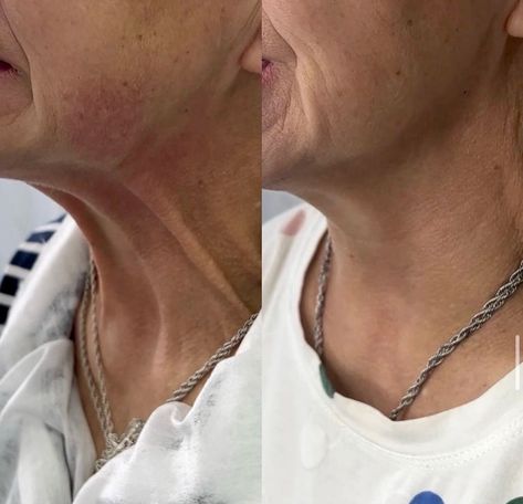 Botox for Platysmal Bands👇🏻  Treating platysmal bands with botulinum toxin leads to reduced appearance of the platysma muscles by simply relaxing the neck muscles.    Dm us or call for all the details 👇🏻 📱 (917) 701-0253  📞 (585)441-3838 📍1934A Williamsbridge Rd, Bronx, NY Platysmal Bands, Neck Muscles, Botulinum Toxin, Botox Fillers, Side Effects, Bronx, The Details, Muscles, Medicine