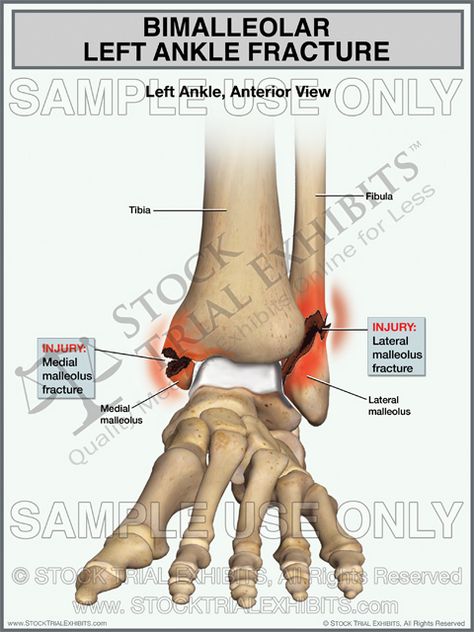 This trial exhibit depicts a bimalleolar left ankle fracture, showing fractures of both the medial malleolus and lateral malleolus, shown in the anterior view with descriptive labels of the anatomy and fracture injuries of the left ankle. Ankle Anatomy, Ankle Ligaments, Ankle Fracture, Presentation Format, Ankle Surgery, Chest Muscles, Medical Illustration, Anatomy And Physiology, Muscle Pain