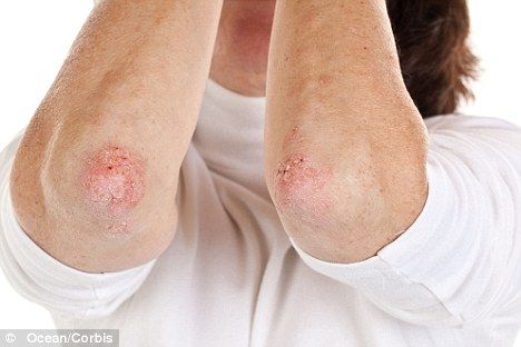 The impact a skin disorder such as psoriasis can have on mental health is too often underestimated by GPs and non-sufferers. Bed Sores, Skin Disorders, Skin Diseases, Natural Treatments, Skin, Red