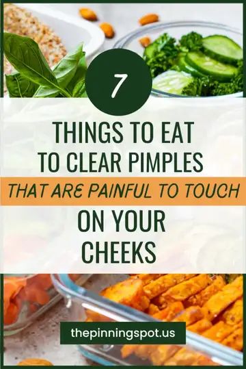 Wondering what toeat for clear skin. Here are 7 foods good for skin. Tese foods get rid of acne super fast from the inside. They are foods I eat for pimple free skin. If you want to learn how to get rid of pimples on cheeks, forehead, that arepainful, read more what to eat for clear skin | foods good for skin | foods to get rid of acne | meals good for acne prone skin | acne friendly meals | foods for pimple fre skin | pimple clearing | ow to get rid of pimples | clear painful pimples on cheeks Foods To Clear Acne, Foods Good For Skin, Eat For Clear Skin, Cheek Pimples, Acne Drink, Clear Acne Fast, Cheek Acne, Clear Pimples, Painful Pimple