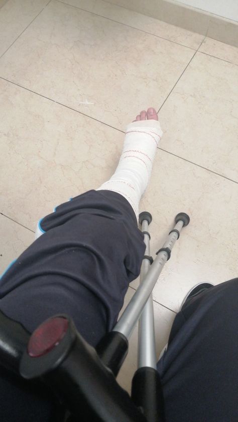 Leg Cast Aesthetic, Leg Fracture Snapchat Story, Injured Leg Fake Story, Fracture Leg Snapchat, Broken Leg Snapchat Story, Leg Fracture Snapchat, Injured Leg Snapchat, Leg Bandage Snapchat, Broken Leg Cast