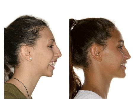 Overbite Correction, After Braces, Orthognathic Surgery, Maxillofacial Surgery, Teeth Aesthetic, Dream Face, Jaw Surgery, Facial Anatomy, Facial Fillers