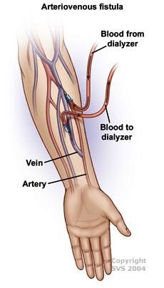 Body Knowledge, Living Kidney Donor, Vascular Ultrasound, Kidney Donor, Vascular Surgery, Picu Nurse, Arteries And Veins, Kidney Friendly, Emergency Nursing