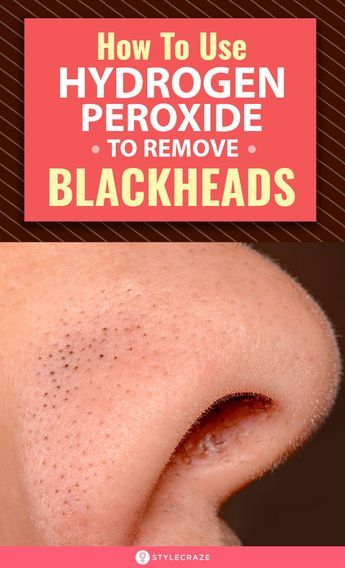 Cold Sore Remedies, To Remove Blackheads, Blackheads On Nose, Black Heads, Remedies For Cough, Rid Of Blackheads, Cold Sores Remedies, Remove Blackheads, Blackhead Removal