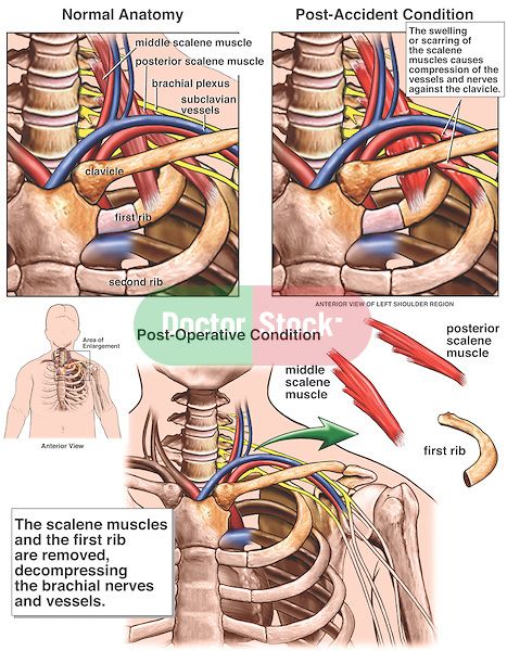 thoracic outlet syndrome - Google Search Thoracic Outlet, Vertebral Artery, Psoas Release, Anatomy Illustration, First Rib, Drawing Anatomy, Illustration Human, Science Quotes, Human Body Anatomy