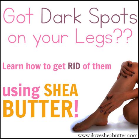 Got Dark Spots on Your Legs? It could be from ingrown hairs, shaving, scars or practically anything out there. Maybe shea butter can help you! Learn how to use it for this particular problem! Dark Spots On Legs Remove Diy, Ingrown Hair Scars Dark Spots, How To Remove Dark Spots On Legs Fast, Dark Spots Under Eyes, Dark Spots On Legs, Natural Beauty Hacks, Dark Spots Remedies, Lavender Room, Spots On Legs