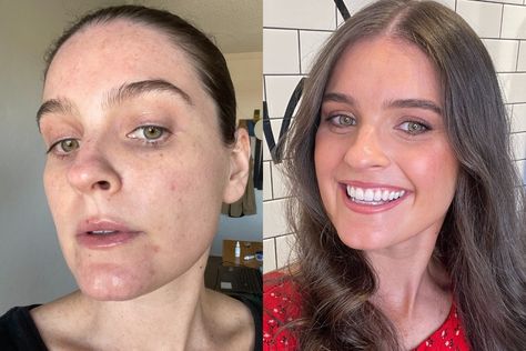 How to clear a cystic pimple, according to an expert. Mario Badescu Drying Lotion, Cystic Pimple, Under The Skin, How To Get Rid Of Pimples, Under My Skin, Cystic Acne, Acne Spots, Cotton Buds, Mario Badescu