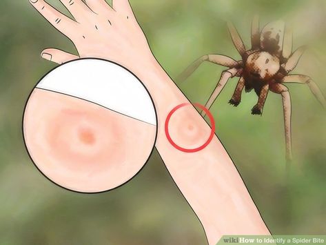 How to Identify a Spider Bite: 7 Steps (with Pictures) - wikiHow Spider Bites Pictures, Spider Identification, Different Spiders, Spider Bite, Bite Relief, Spider Species, Spider Bites, Medical Information, Too Short