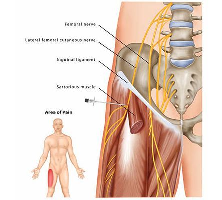 Peripheral Nerve Block - Pain management clinics in Las Vegas | Nevada Comprehensive Pain Center Femoral Nerve, Pinched Nerve, Peripheral Nerve, Nerve Pain Relief, Knee Exercises, Sciatica Pain, Leg Pain, Hip Flexor, Medical Illustration