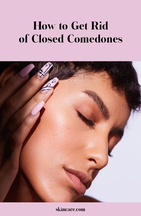 Whiteheads, a.k.a closed comedones, are tiny white bumps that are caused by clogged pores. Read on to see how to get rid of them for a clear complexion. Clogged Pores On Chin, Congested Skin Clogged Pores, How To Get Rid Of Closed Comedones, White Bumps On Face, Closed Comedones, Best Peel Off Mask, Get Rid Of Pores, Skincare Solutions, Skincare Advice