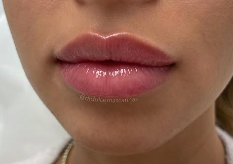 Bow Lips Shape, Lip Filler With Cupids Bow, Lip Filler Cupids Bow, Sharp Cupids Bow Lips, Defined Cupids Bow Lips, Pretty Lips Natural, Bow Shaped Lips, Versa Lip Filler, Lip Filler Styles