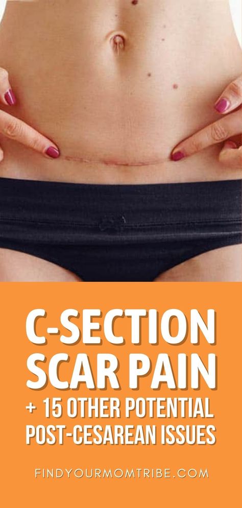 C-section scar pain can be annoying to deal with, but it's not the only aftereffect of a C-section delivery. See the others here. C Section Scar Healing, Section Scar Tattoo, C Section Scar Tattoo, C Section Scar, Lower Abdominal Pain, Hypertrophic Scars, C Section Scars, Mommy Things, Growing Healthy Hair