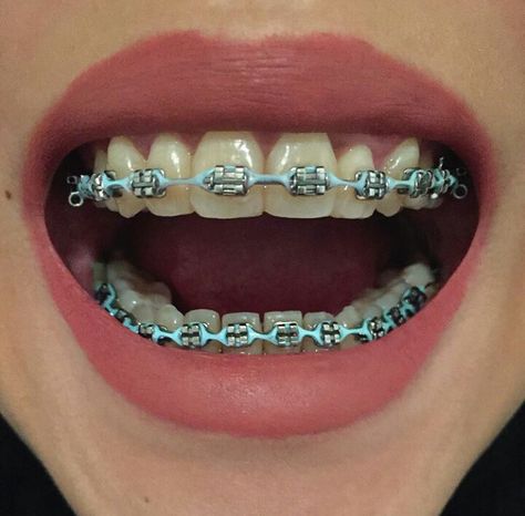 #braces #girlswithbraces #powerchain #headgeartubes Light Blue Braces, Braces Colors Combinations, Blue Braces, Braces Retainer, Braces Colors Ideas, Ear Tubes, Cute Braces Colors, Adult Braces, Braces Tips