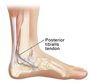 Side inside view of bones of lower leg and foot showing Achilles tendon and posterior tibialis tendon. Posterior Tibialis Shin Splints, Tibialis Posterior Exercise, Posterior Tibialis, Posterior Tibial Tendon Dysfunction, Torn Ligament In Ankle, Posterior Tibial Tendon, Tibialis Posterior, Soleus Muscle, Ankle Ligaments