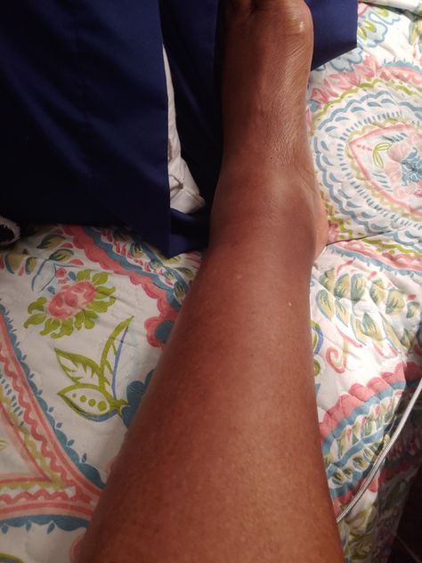 Broken Ankle, Swollen Ankles, Foto Fake, Swollen Legs, Black Person, Mens Health, Disease, Juice, Take That