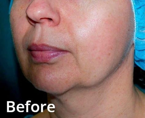 Morpheus8 | £600 P/S | Improve Skin Laxity | Book Now Morpheus 8 Before And After, Morpheus 8, Turkey Neck, Cover Face, Shiny Skin, Face Lift, Loose Skin, Sagging Skin, Radio Frequency