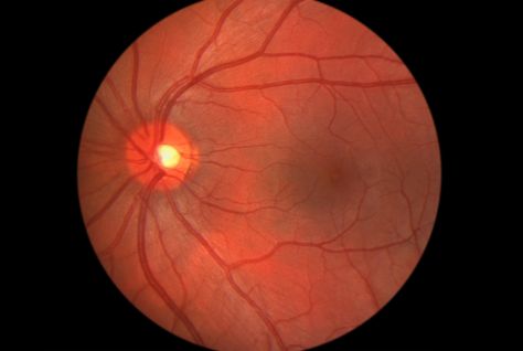 RIKEN Resuming First Ever Clinical Study of iPSC-Derived Cells in Humans Posterior Vitreous Detachment, Visual Processing, Degenerative Disease, Eye Exercises, Gene Therapy, Healing Touch, Cleveland Clinic, Eyes Problems, Eye Health