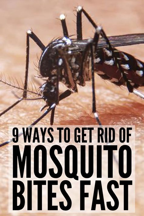 How To Stop The Itch Of Mosquito Bites, What Is Good For Mosquito Bites, Diy Mosquito Bite Itch Relief, What To Use For Mosquito Bites, What To Do For Mosquito Bites, Natural Itch Relief For Bug Bites, Remedy For Mosquito Bites Itch Relief, Mosquito Bites Remedy, How To Help Bug Bites