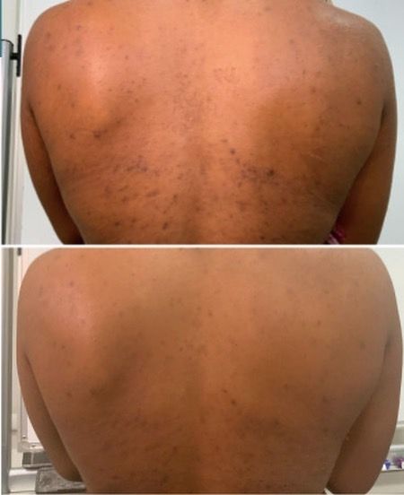 Chemical Peel Before And After Black, Chemical Peel Aesthetic, Chemical Peel Before And After, Why Is My Skin Peeling, Full Body Chemical Peel, Vi Peel, All Skin Colors, Medi Peel, Skin Peeling On Face