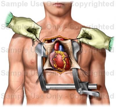 Open Heart Surgery Heart Facts, Lady Lawyer, Human Heart Anatomy, Heart Warrior, The Surgeon, Medical School Life, Perfect Heart, Open Heart Surgery, Congenital Heart Defect