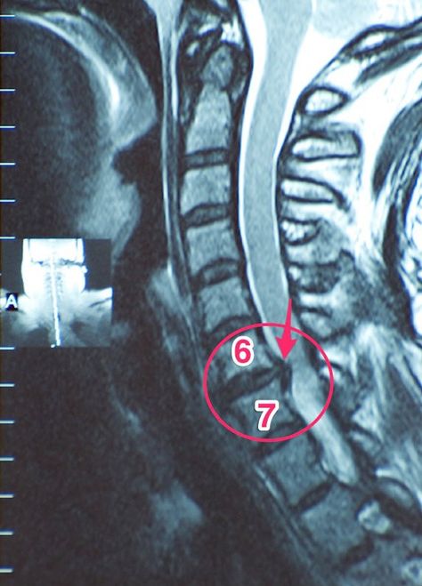 C6-C7 Herniated Disc Symptoms | Mom Experiencing Life Again with Cervical Disc Arthroplasty Herniated Disk In Neck, Cervical Disc Herniation, Cervical Disc, Cervical Pain, Anatomy Bones, Disk Herniation, Bulging Disc, Neck Surgery, Pinched Nerve