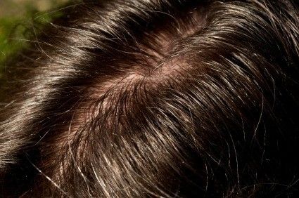 This is a guide about remedies for greasy hair. No one likes their hair to look stringy and greasy. If your hair is extra oily though it can be difficult to avoid having your hair look that way. Hair Highlights And Lowlights, Greasy Hair, 50 Hair, Oily Scalp, Healthy Hair Tips, Greasy Hair Hairstyles, Hair Solutions, Hair Remedies, Dry Scalp