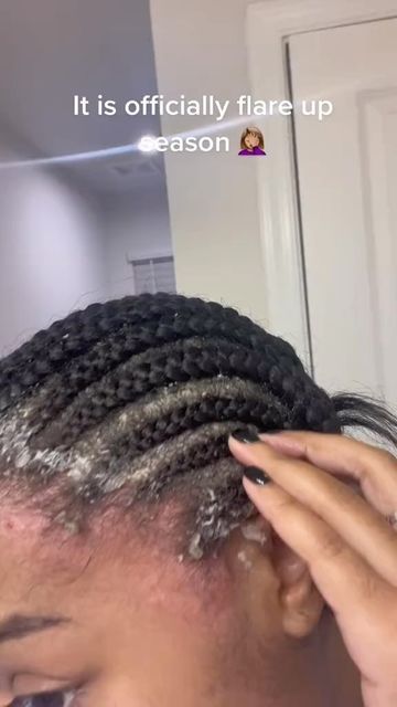 salonready_com on Instagram: "*Transparent post* I hateeee dealing with seborrheic dermatitis times like these I just wanna shave my head bald! I’ve had these braids in 2 weeks today . No matter the style this time of year my entire body is under attack ! ❤️ Follow me to get more inspiration and start your pretty look with us @salonready_com . . . #bohobraids #twobraids #feedinbraids #feedinstyles #naturalhair #naturalhairspo #natural #cutestyles #blackgirl #blackhairstyle #braid #twisttutorial No Style Haircut, Natural Hair Styles Braids, Gray Haircuts, Short Grey Haircuts, Pretty Hair Cuts, Scalp Braids, Curly Hair Beauty, Pretty Braids, Shave My Head