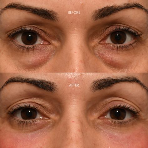 Post-op from a lower blepharoplasty and contour TRL. Our patient shows stunning results just 1 month after her surgery! Contact us today! 212.229.1100 info@eskmd.com #drkwak #dredwardskwak #plasticsurgery #plasticsurgeon #cosmeticsurgery #cosmeticsurgeon #facialaesthetics #facialplastics #antiaging #beforeandafter #beforeafter #bleph #blepharoplasty #eyelid #eyelids #eyes #darkcircles #lowerbleph #lowerblepharoplasty #medspa #beauty Facial Aesthetics, Facial Plastic Surgery, Facial Plastic, Post Op, Med Spa, Plastic Surgeon, Cosmetic Surgery, 1 Month, Plastic Surgery