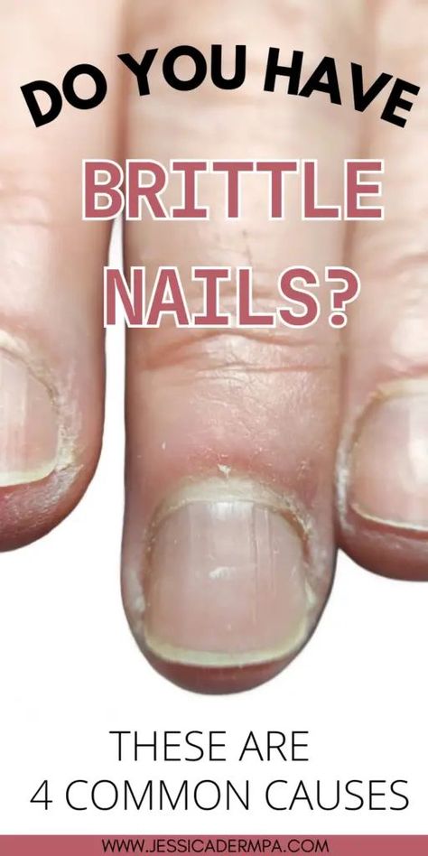 fungal nail treatment remedies Take Off Acrylic Nails, Nail Disorders, Nail Remedies, Nail Fungus Remedy, Nail Infection, Fungal Nail, Weak Nails, Fungal Infection, Brittle Nails