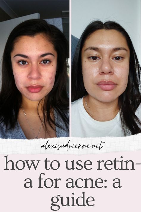 this is a guide for how to use retin-a for acne and wrinkles. it doesn't matter if it's retin-a cream or gel that you have, any tretinoin product works the same for acne and wrinkles. Retinoids Before And After, A313 Cream, Tretinoin Progress, Retin A Before And After, Tretinoin Before And After Acne, How To Use Tretinoin Cream, How To Apply Tretinoin Cream, Skincare Tretinoin, Retin A Cream