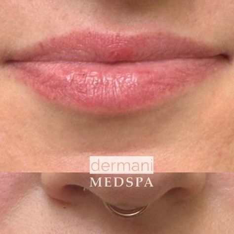 Before and After Lip Filler - Dermani Medspa Park Ridge Versa Lip Filler, Lip Filler M Shaped Lips, 1ml Juvederm Lips, Lip Injections Before And After 0.5ml, .5 Syringe Lip Filler, Mommy Makeover, Lip Filler, Lip Injections, Lip Fillers