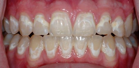 Teeth After Braces, Invisible Teeth Braces, Dental Ideas, After Braces, Braces Pain, Natural Teeth Whitening Diy, Misaligned Teeth, Kids Braces, Invisible Braces