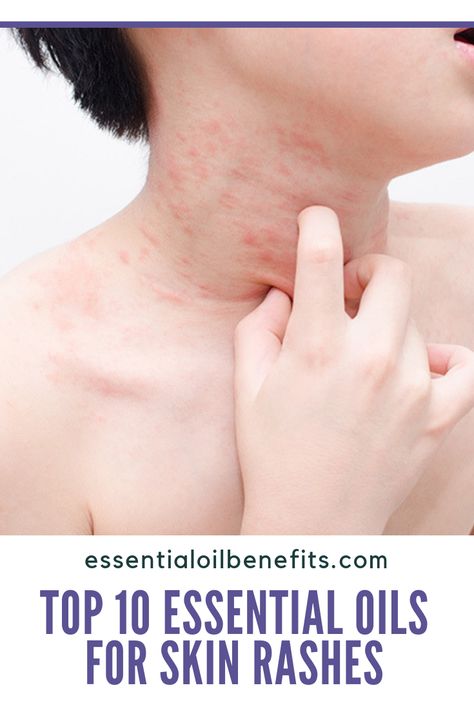 Essential Oil Recipes For Skin Rashes, Essential Oils For Rashes Skin, Essential Oils For Itchy Rash, Essential Oils For Itching Skin, Essential Oil For Skin Irritation, Essential Oils For Rash And Itching, Natural Remedies For Rashes, Essential Oils For Itchy Skin, Essential Oils For Rash