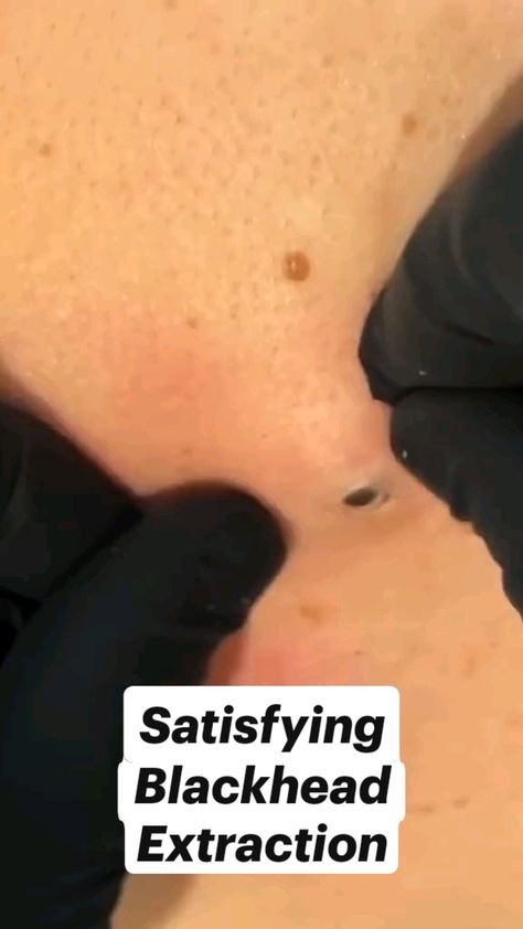 Satisfying Blackhead Removal Blackheads Removal Homemade, Skin Extraction, Blackheads Removal Satisfying Videos, Black Head Removal Video Nose, Pimple Poppìng, Huge Blackheads, Blackheads Removal Cream, Ear Pimple, Painful Pimple