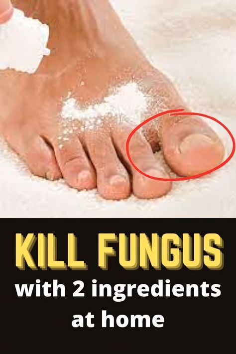 Fungal Nail Infections How To Get Rid Of Toenail Fungus Fast, Toe Nail Fungal Infection, Tea Tree Oil For Toenail Fungus, Home Remedies For Toenail Fungus, Tea Tree Oil For Nail Fungus, Fungal Infection Remedies, Home Remedies For Sunburn, Aloe Vera For Sunburn, Fingernail Fungus